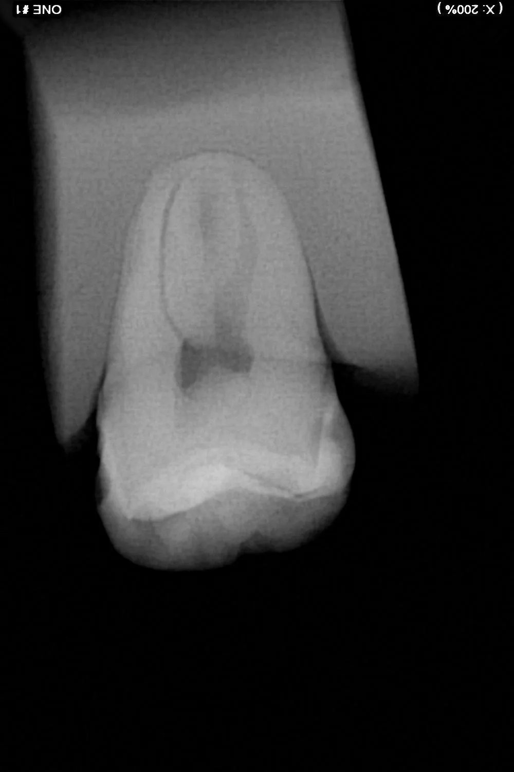 Radio d'une endodontie