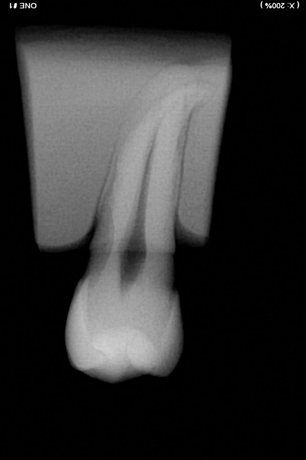 Radio d'une endodontie