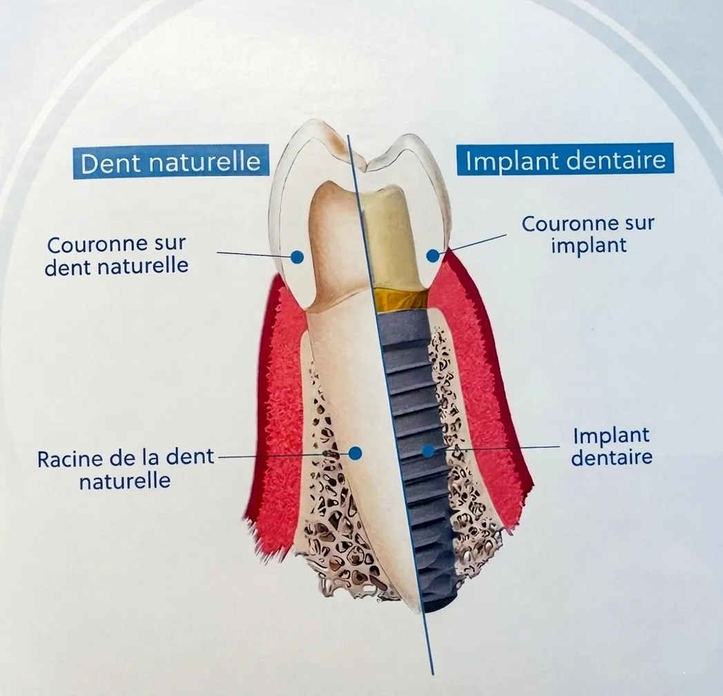 image d'un implant